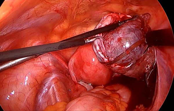 Dermoid Ovarian  Cyst Surgery in Kolkata