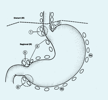 Rationale of excising a Cancerous Growth
