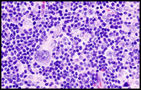 Hodgkin Lymphoma 