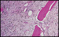 Myelofibrosis