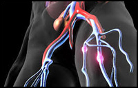 VTE (Venous Thrombo Embolism)