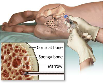 Bone Marrow Examination