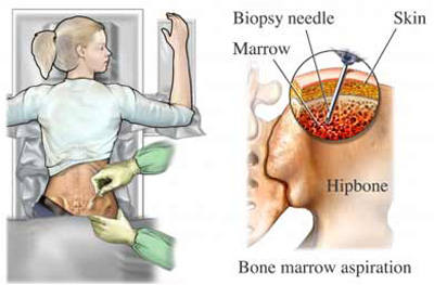 Bone Marrow Examination