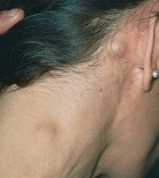 Hodgkin lymphoma