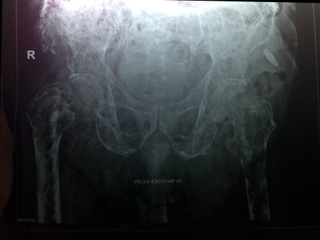 Multiple Myeloma