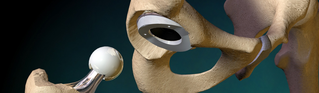 Total Knee Arthroplasty in Kolkata