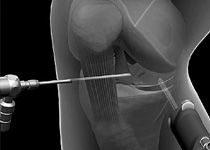 Knee Arthroscopy in Kolkata