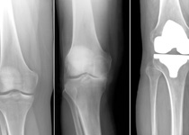 Best Knee Replacement Surgery in Kolkata