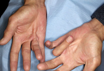 Dupuytren's Disease