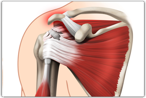 Rotator Cuff Tear