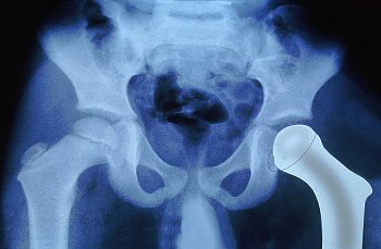 Total Hip Replacement Surgery 