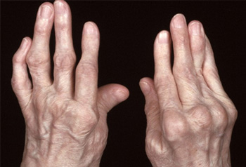 RHEUMATOID ARTHRITIS