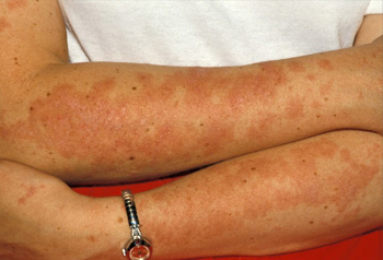 Lupus known as SLE (Systemic Lupus Erythematosus)