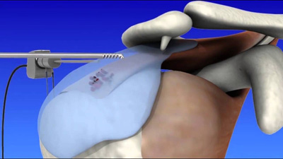 Shoulder Arthroscopy Surgery in Kolkata