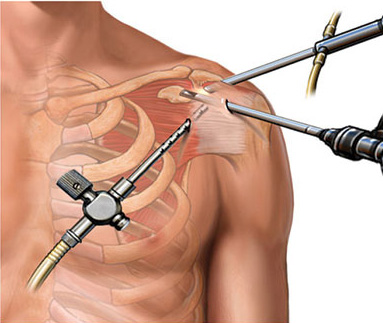 Shoulder Arthroscopy Doctor in Kolkata