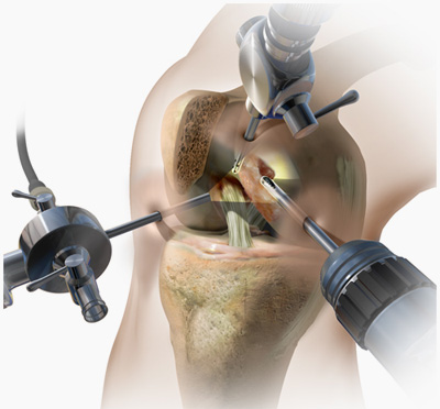 Knee Arthroscopy