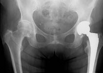 Total Hip Replacement in Kolkata