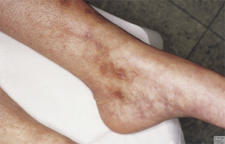 Antiphospholipid Syndrome