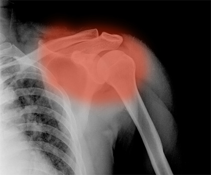 Frozen Shoulder