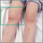 Juvenile Chronic Arthritis