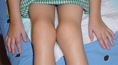 Juvenile Chronic Arthritis