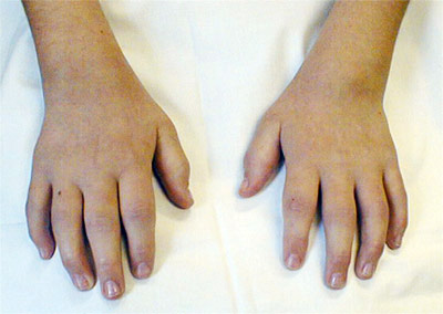 Juvenile Chronic Arthritis
