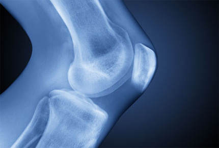 Osteoarthritis