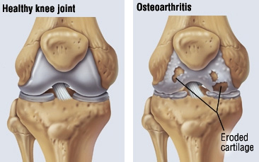 Osteoarthritis