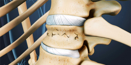 Osteoporosis