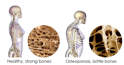 Osteoporosis