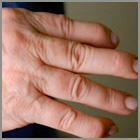 Psoriatic Arthritis