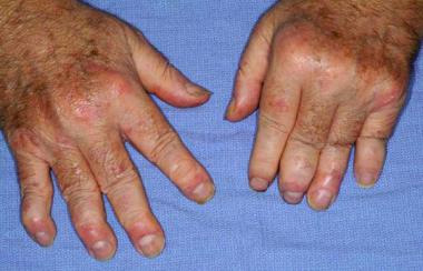 Psoriatic Arthritis