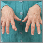 Rheumatoid Arthritis