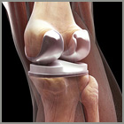 Total Knee Replacement