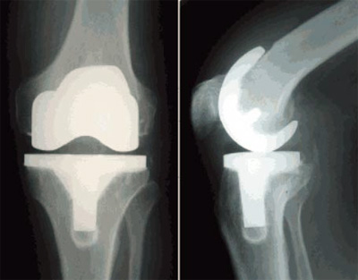 Total Knee Replacemente