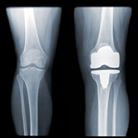 Total Knee Replacement