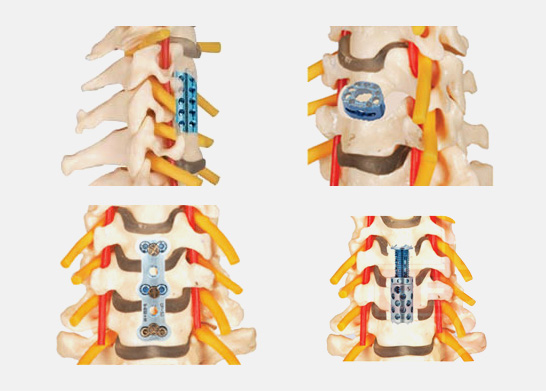 Neha Surgical - Authorised Dealer of Spinal Implants, Instruments and Hospital Equipments