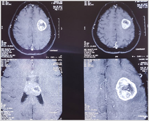 Brain Tumour Pre Ooperation