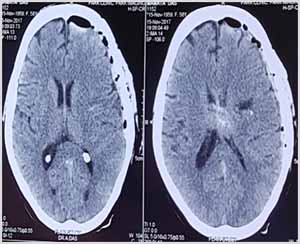 Brain Tumour Post Ooperation