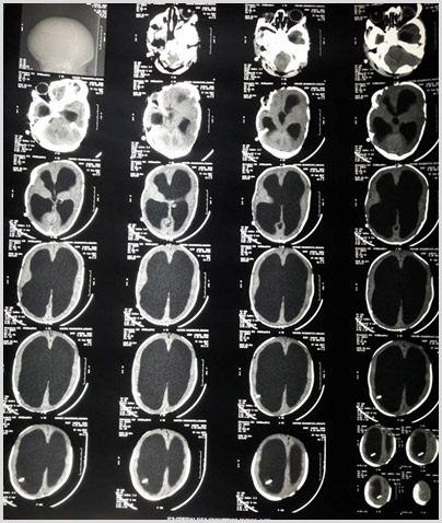 Hydrocephalus