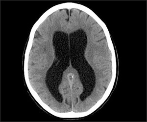 Hydrocephalus