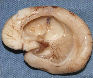 Hydrocephalus