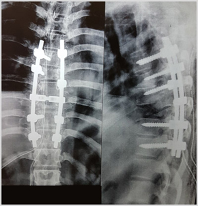 Spinal Trauma Post Ooperation