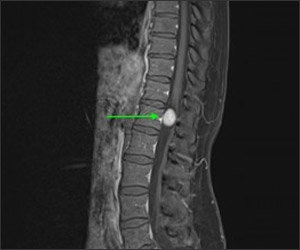 Spinal Tumour