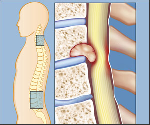 Spinal Tumour