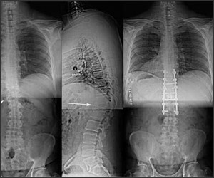 Spinal Tumour