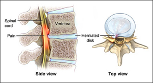 Spinal Tumour