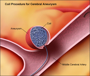 VASCULAR NEUROSURGERY