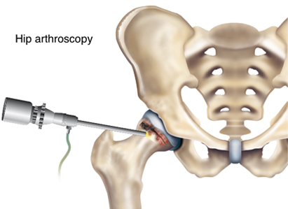 Elbow, Wrist, Hip and Ankle Arthroscopy