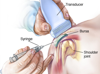 Bursitis